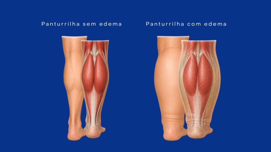 demonstração panturrilha sem edema e com edema.