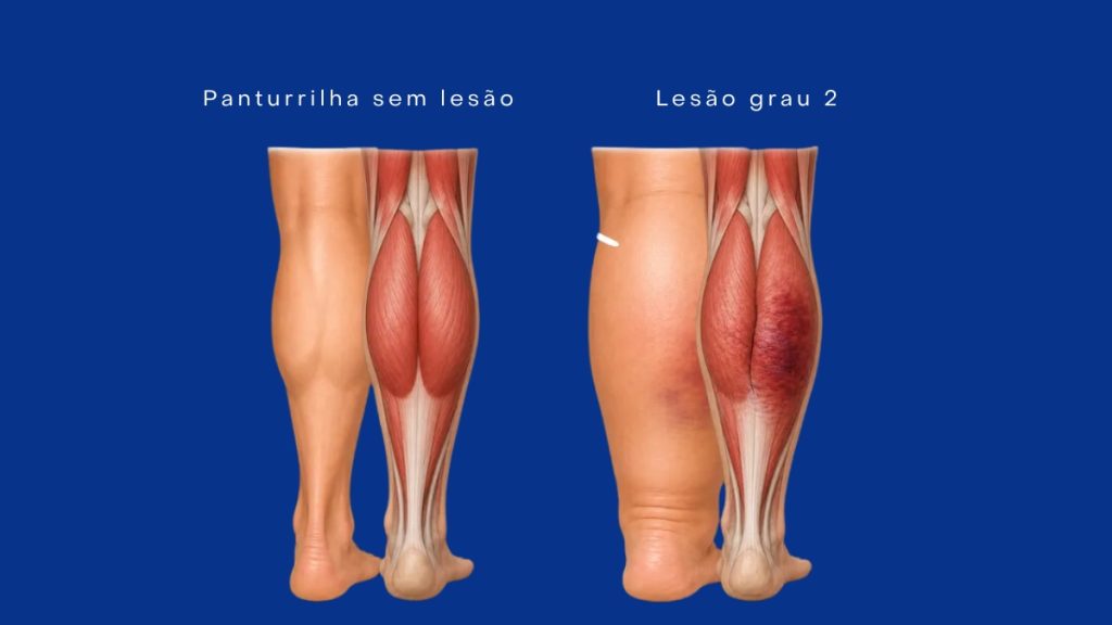 demonstração da lesão do Neymar na panturrilha, sem lesão grau 2 e com lesão grau 2