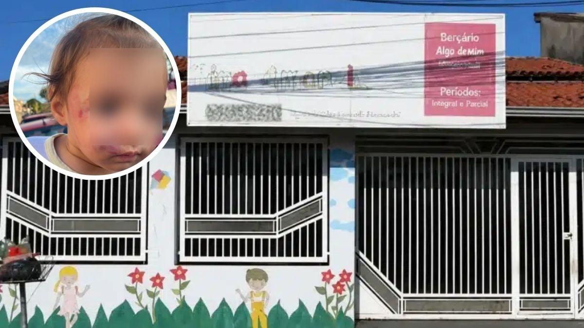 Após bebê sofrer lesões no rosto, Prefeitura descredencia creche em Sumaré