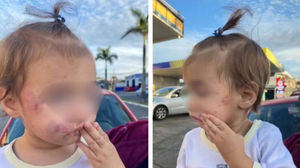 bebê que sofreu lesões no rosto após voltar de creche em Sumaré
