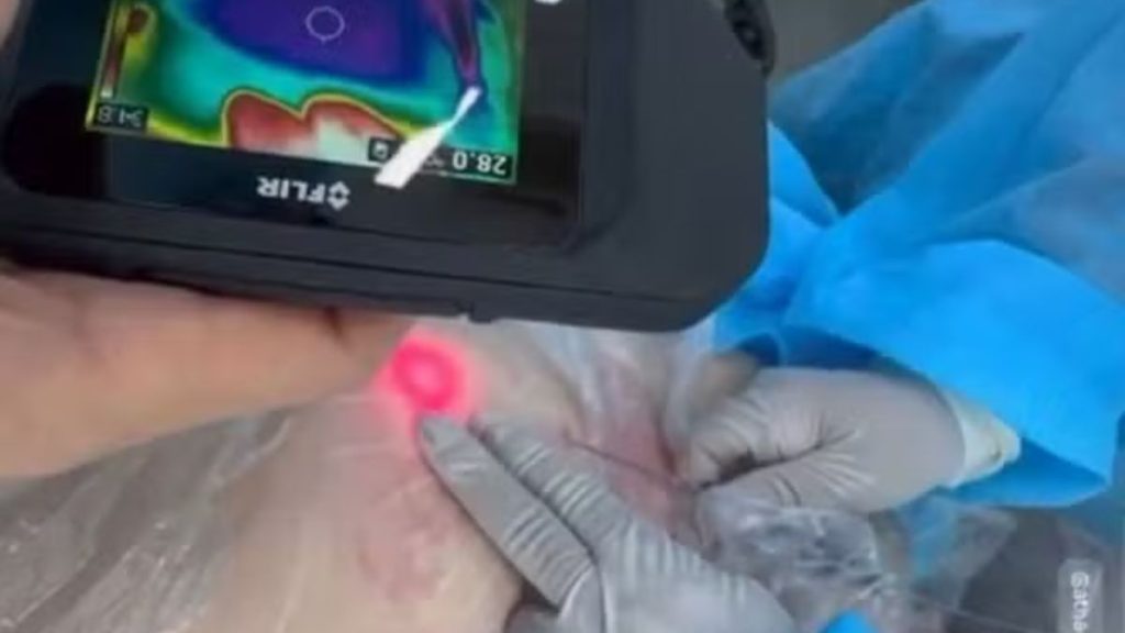 Esteticista presa Santos em procedimento estético com laser em paciente, com profissional usando luvas descartáveis e máscara de proteção, em clínica, durante fiscalização.