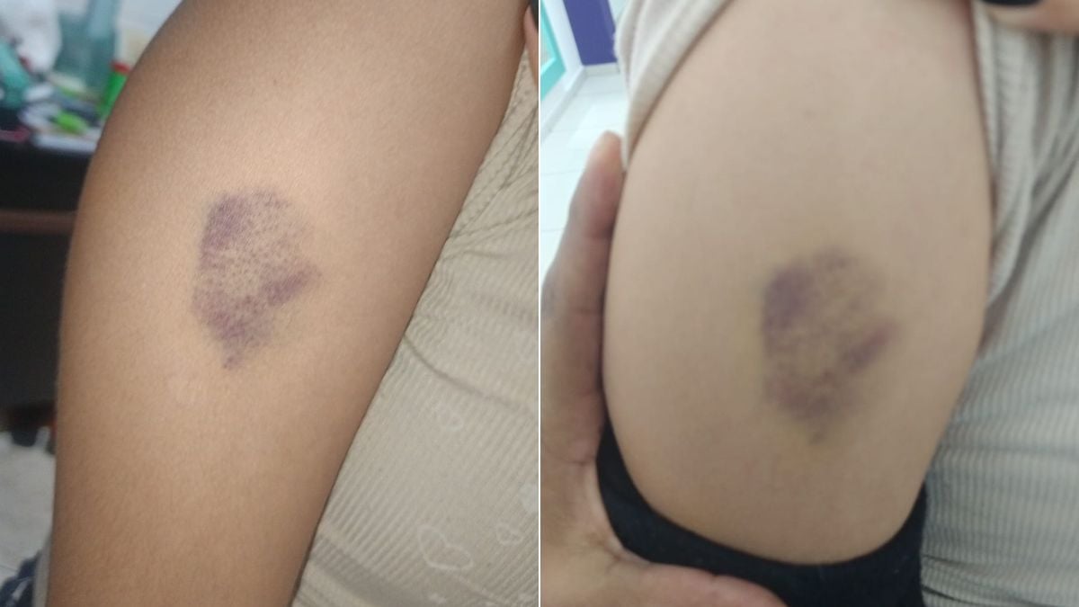 Imagens mostram marcas de agressão e hematomas no braço e nas costas de uma menina de 11 anos, em contexto de denúncia de violência após agressão em escola de Praia Grande.