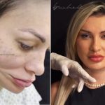 Andressa Urach faz 50ª cirurgia plástica; veja o antes e depois do rosto da atriz