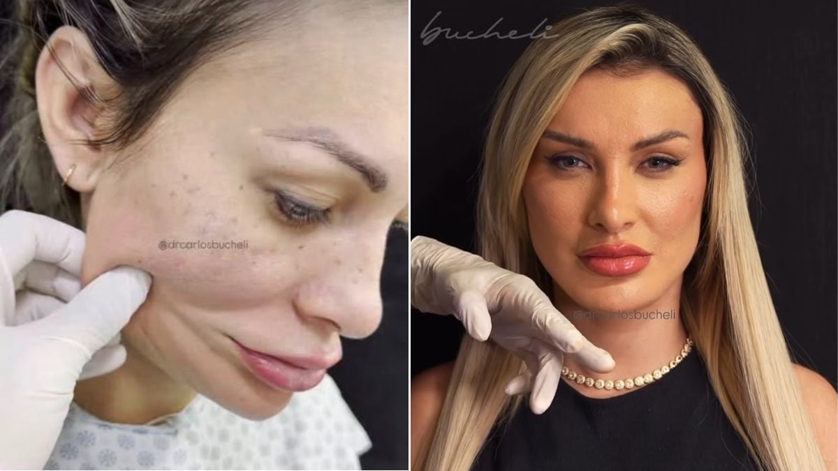 Andressa Urach faz 50ª cirurgia plástica; veja o antes e depois do rosto da atriz
