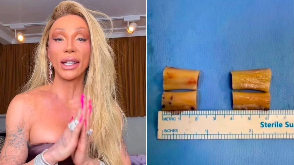 Maya Massafera retira curativo da cirurgia