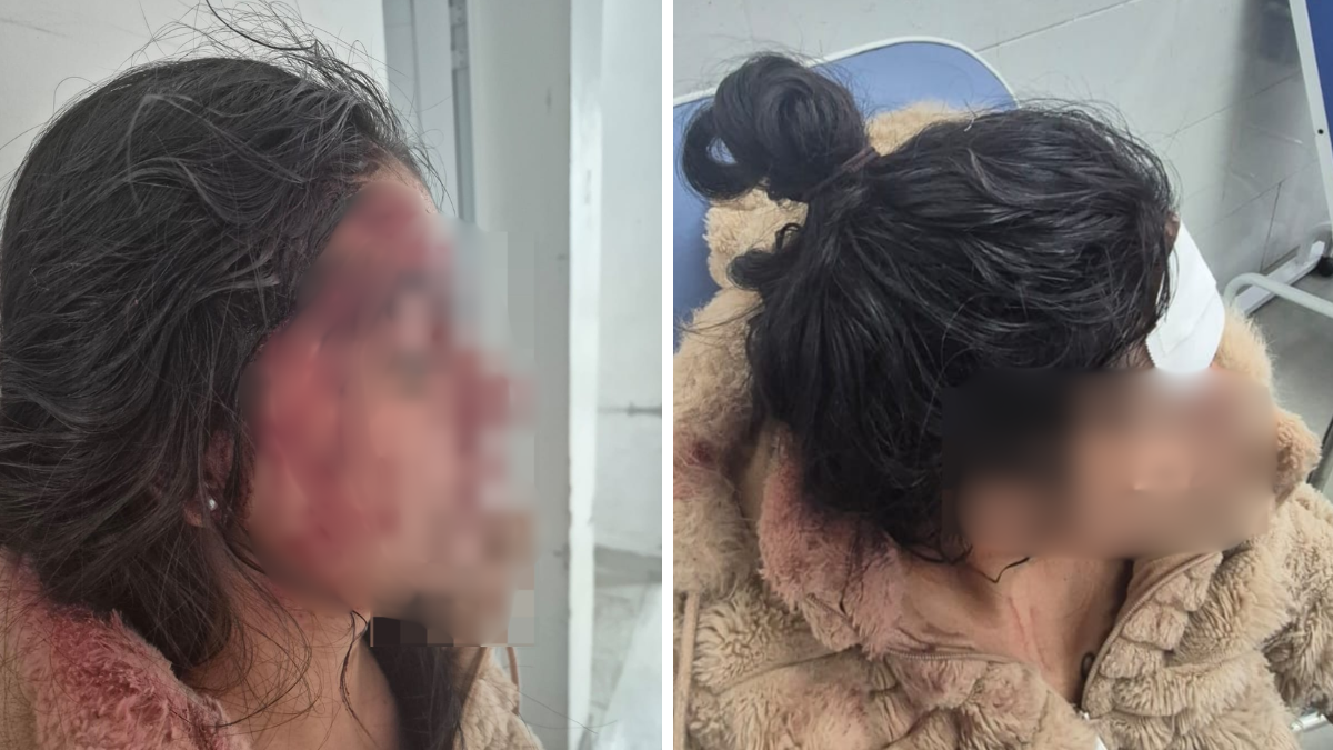Cenas de uma mulher com ferimentos e rosto parcialmente coberto, em ambiente interno, após escapar de cárcere privado em Piracicaba após denúncias de agressões.