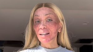 Maya Massafera faz peeling no rosto e surge com o mesmo inchado