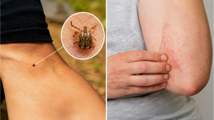 Febre maculosa em Campinas e Piracicaba: Imagem mostra picada de carrapato na pele e inseto ampliado em detalhe, sugerindo febre maculosa. Pessoas em Campinas e Piracicaba com alerta em SP.