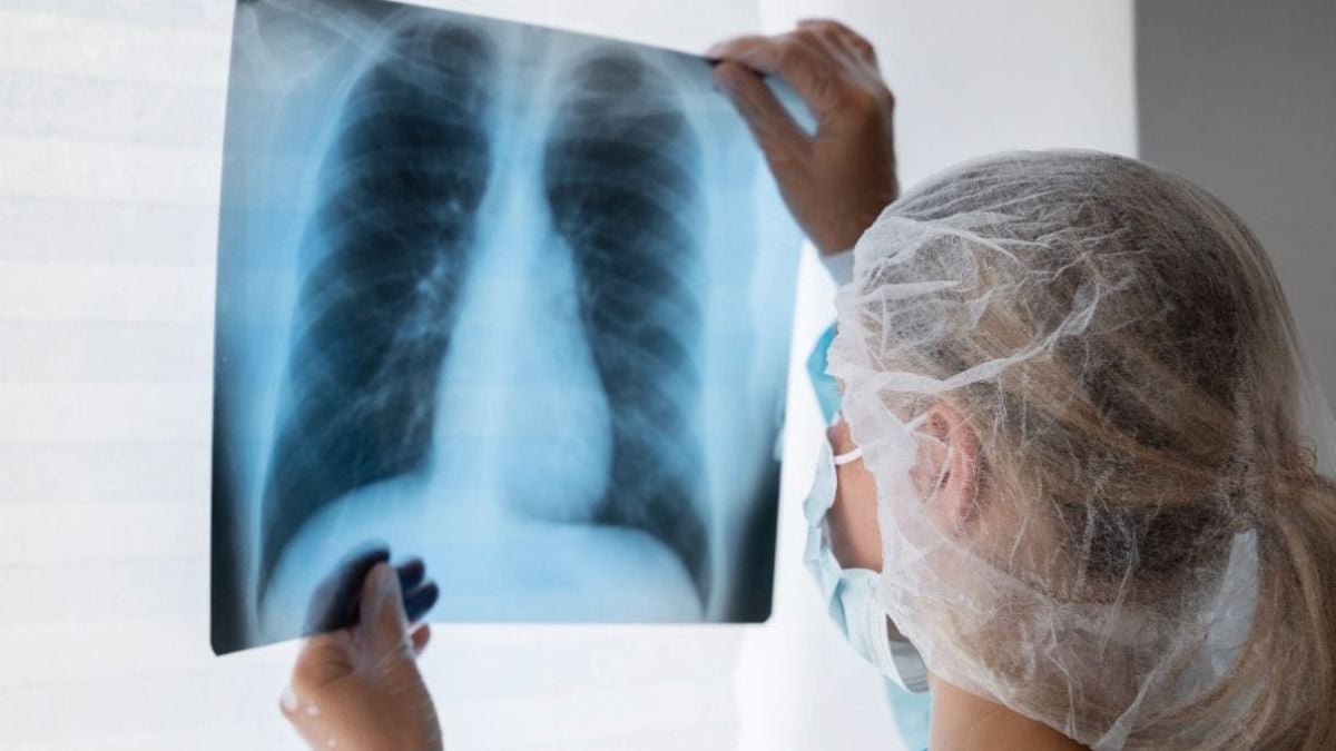 Médica com roupa de proteção e máscara observa um exame de raio-X do tórax exibindo pulmões, em contexto de aprovação de novo medicamento para câncer de pulmão pela Anvisa.