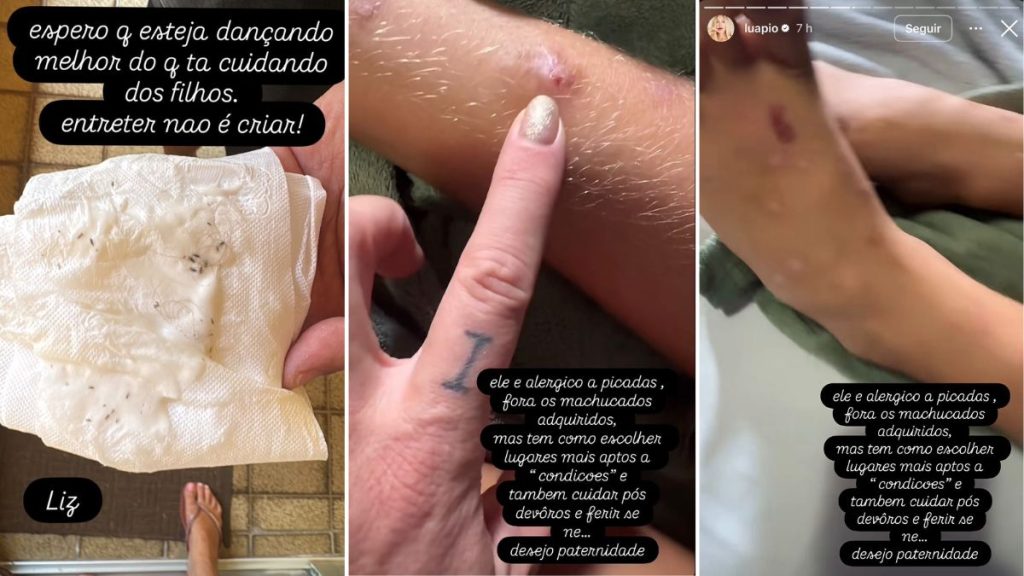 Luana Piovani critica Pedro Scooby em stories após encontrar piolho na filha, com imagens de um tecido e aproximações da pele e anotações sobre cuidados e alergias
