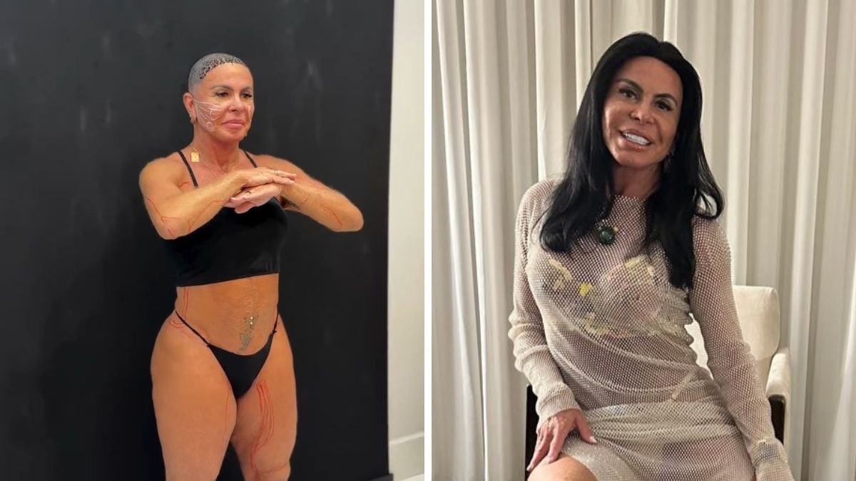 Gretchen faz tratamento contra flacidez no rosto e no corpo: ‘Ficando incrível’
