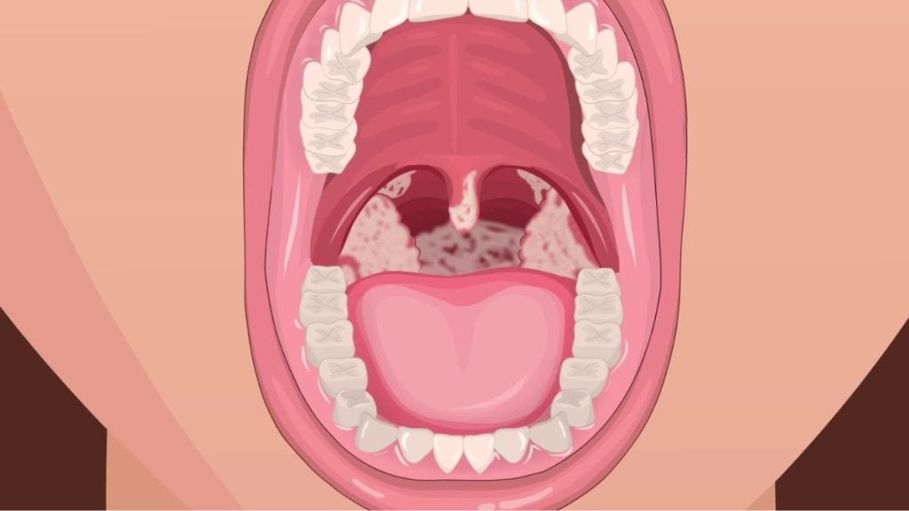 Ronaldo Caiado: Ilustração médica em estilo cartoon de uma boca aberta com dentes e gengiva, mostrando a região da garganta e estruturas internas.