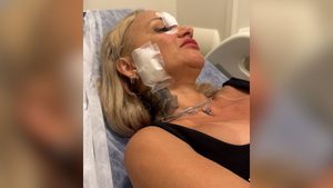 Cabeleireira agredida em Praia Grande aparece em foto de atendimento, com gaze e curativo no rosto após agressão com taça de vidro, na saída de bar.