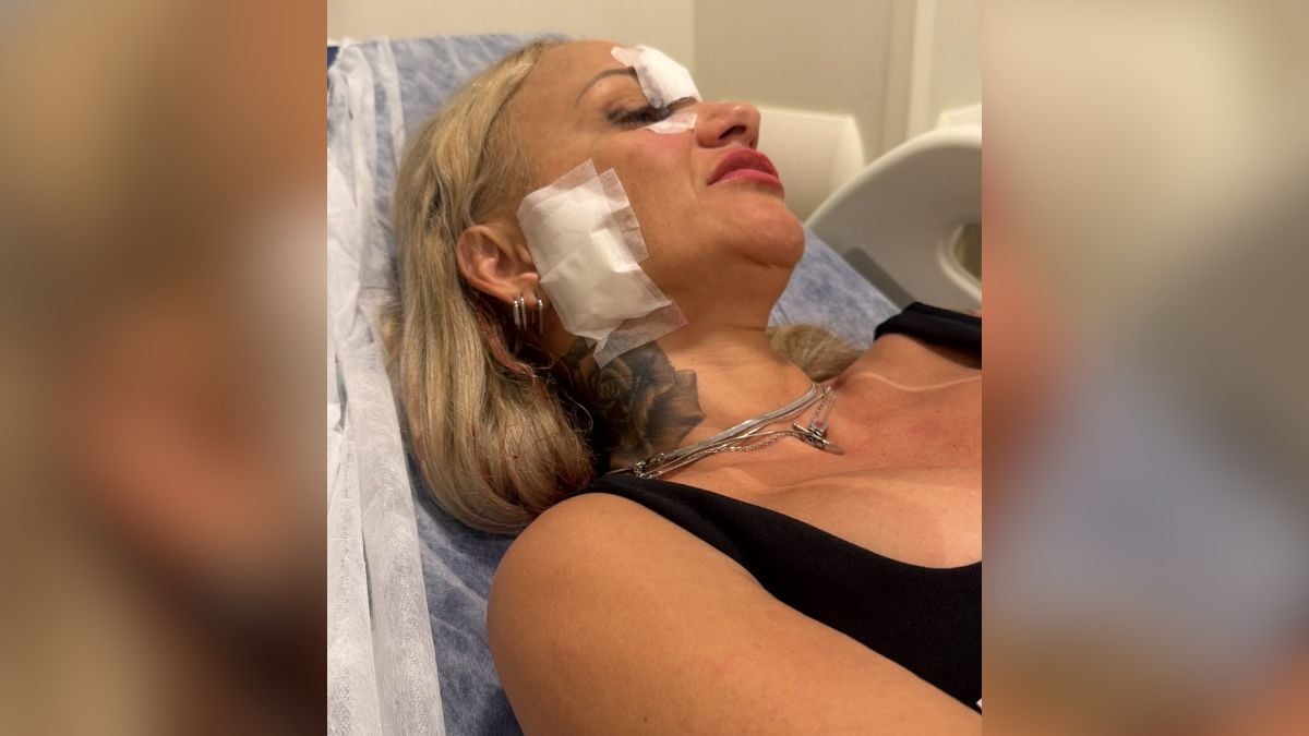 Cabeleireira agredida em Praia Grande aparece em foto de atendimento, com gaze e curativo no rosto após agressão com taça de vidro, na saída de bar.
