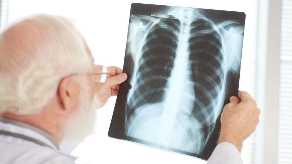 Médico analisando uma radiografia do tórax com foco nos pulmões, ilustrando Nódulo pulmonar: o que é, quais os sintomas e quando pode ser câncer?