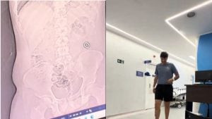 Jovem engole aliança durante brincadeira, vai ao hospital em Santos e vídeo viraliza